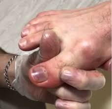 Informations sur les formes de traitement dans le centre pour le traitement du most cancers à kehl. Ongle Bleu L Hematome Sous Ungueal Pedicure Podologue Sete