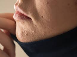 Sufres De Acne Por Mascarilla O Maskne Aprende Como Combatirlo Clinica Indisa Clinica De Familia