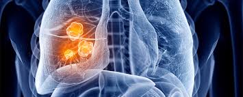 Lung cancer is the leading cause of cancer deaths in both women and men in the united states, canada, and china. Non Small Cell Lung Cancer Archives Research Outreach