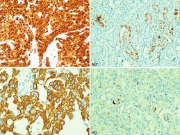 Malignant pleural mesothelioma (mpm) is considered to be a relatively rare tumour, although incidence has increased during the last ten years. A And B Calretinin Staining A Malignant Mesothelioma Has Diffuse Download Scientific Diagram