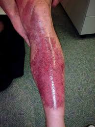 Image result for erysipel photos)
