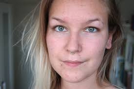 Huidkanker komt vooral voor in het gezicht, bij de oren, lippen, in de nek en op de handruggen. Hormonale Acne Door Stoppen Met De Pil Ikbenirisniet