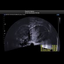 Wenn viele myome über die gebärmutter verteilt auftreten spricht man von einem uterus myomatosus. Ultraschall Bild1 Myom Gebaermutter Steinert Frauenarztin