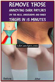 Remove Those Annoying Dark Patches On The Neck Underarms And Inner Thighs In 15 Minutes Health Care News Dark Patches On Skin Dark Underarms Dark Armpits