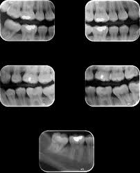 Radiografia Bite Wing Ou Raio X Interproximal New Imagem Diagnostico