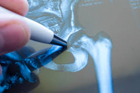 Une opération s'impose , sa hanche est atrophiée, je souhaiterai que vous indiquiez les meilleurs hopitaux de france (par experience ou renommée) yuna. A Toulouse Centre De Chirurgie De La Hanche Toulouse