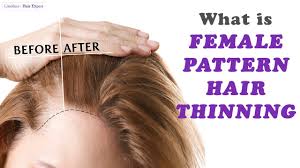 When the balance is interrupted — when hair falls out and less hair grows in — hair loss happens. Everything Women Should Know About Female Pattern Hair Thinning Hair Expert Dino Youtube