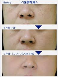 フォトフェイシャル ファースト 違い