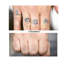 Temporary tattoos last up to two weeks max, while permanent tattoos last a lifetime (unless you decide to go for laser tattoo removal). Tattoo Removal Everything You Should Know Before You Get A Tatt Saved Tattoo