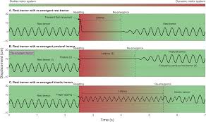 Image result for Rest Tremor