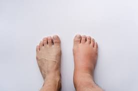Kaki bengkak bisa disebabkan oleh berbagai hal, mulai dari hal yang ringan sampai hal yang lebih serius, seperti penyakit serius. 5 Cara Mudah Meredakan Kaki Bengkak