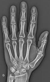 Image result for Glomus tumor