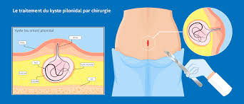 Visible et palpable, il peut se localiser dans n'importe quelle partie du revêtement cutané. Traitement D Un Kyste Ou Sinus Pilonidal Avec Un Gel Antibacterien Au Miel De Manuka Apres Incision Et Drainage