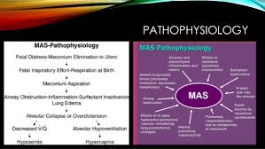 Meconium Aspiration Syndrome Mas