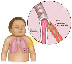 Normally these symptoms will clear up on their own in a few days. Patient Education Bronchiolitis And Rsv In Infants And Children Beyond The Basics Uptodate