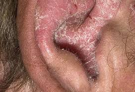Slideshow Types Of Psoriasis Psoriasis Remedies Scalp Psoriasis Treatment Psoriasis Cure