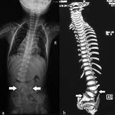 Radiology Of A 2 Year Old Boy Diagnosed With Vacterl Association Download Scientific Diagram