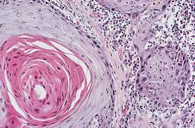 Ductal carcinoma is the most common type of breast cancer. Tumor Markers Definition And Examples