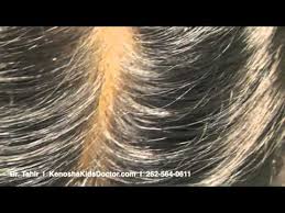 What do nits look like? What Lice And Their Eggs Look Like Youtube