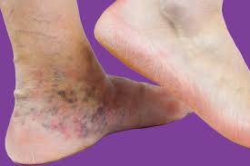 Image result for Stasis Dermatitis