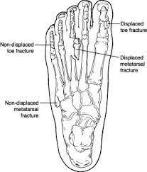 Maybe you would like to learn more about one of these? Broken Toes Fractured Toe Pain Foot Health Facts Foot Health Facts