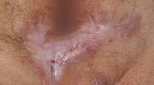 The groin area has a constant supply of moisture. Hs Symptoms Pictures No Bs About Hs