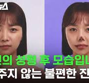 '성형 비포 애프터?' 성형정보 앱 회사에서 성형 부작용을 알리는 이유 / 스브스뉴스