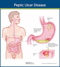 Peptic Ulcer Disease Nursing Care And Management Study Guide Peptic Ulcer Ulcers Peptic Ulcer Diet
