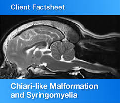 Image result for Syringomyelia