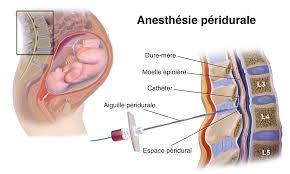 Après l'accouchement, j'ai eu mal au dos, mais mal au dos, c'était l'enfer. Peridurale Service D Anesthesie