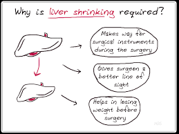 Maybe you would like to learn more about one of these? Pre Op Bariatric Diet Liver Shrink Diet