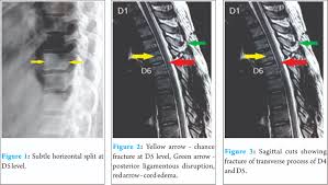 Image result for Chance Fracture