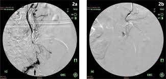 Nonproprietary name sodium tetradecyl sulfate injection. Foam Sclerotherapy During Shunt Surgery For Portal Hypertension And Varices