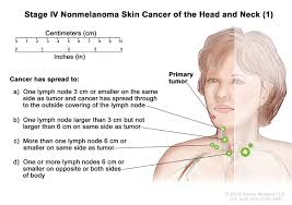 Skin Cancer Types Symptoms Information Dana Farber Cancer Institute Boston Ma