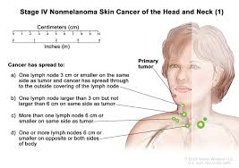 Some cancers cause swelling of the lymph nodes. Skin Cancer Types Symptoms Information Dana Farber Cancer Institute Boston Ma