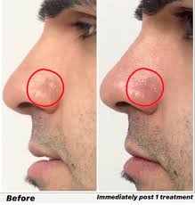 They are usually harmless, but may be associated with several diseases. Telangiectasia Hashtag On Twitter