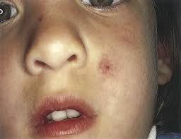 Alterations in Hemostasis and Blood Coagulation