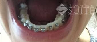 During this time, you should eat soft foods such as yoghurt, boiled vegetables, stewed fruit and thin soups to avoid putting additional pressure on your brackets. My Straight Teeth Journey By Raha Sepehrara In Nottingham Part Two