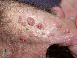 Many tumors are asymptomatic and may be diagnosed incidentally. Cara Mudah Menghilangkan Kutil Tumor Fibroid Pengetahuan Kesehatan672