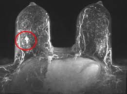 Breast mri is not a substitute for a mammogram. Uh Posts Noteworthy Early Results Program Has Identified 19 9 Breast Cancers Per 1000 Studies University Hospitals