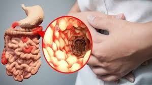 Crohn's Disease Treatment Market to Surpass US$ 10 Billion by 2026