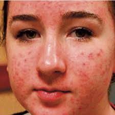 Using controlled flashes of light to penetrate the skin, bbl damages the hair follicle to prevent regrowth. Broadband Light Bbl How It Works Cost Safety Realself
