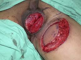 The disease is most often found in men between the ages of 50 and 60. Reconstruction Of Scrotal And Perineal Defects In Fournier S Gangrene Journal Of Plastic Reconstructive Aesthetic Surgery