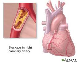 Image result for Hypercholesterolemia