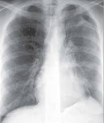 Image result for Atelectasis