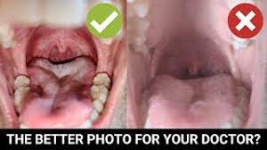 Maybe you would like to learn more about one of these? Send A Photo Of Your Throat To Your Doctor Youtube