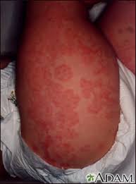 Both basal and squamous cell carcinoma, the two most common types of skin cancer, could be found on the lip. Purpura Information Mount Sinai New York