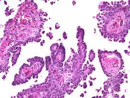 Epithelioid mesothelioma is the most frequent difficulty to differentiate from other myxoid lesions of the peritoneum (e.g. Webpathology Com A Collection Of Surgical Pathology Images