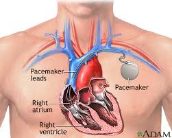 The device stan has is the syncardia temporary total artificial heart, a mechanical pump to bridge him to transplantation, says university of michigan cardiac surgeon jonathan haft, m.d. Heart Pacemaker Medlineplus Medical Encyclopedia