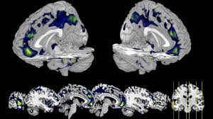 How the brains of murderers look different | University of Chicago News